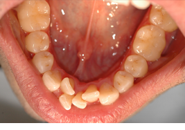crowding-before-lower-arch-invisalign-final