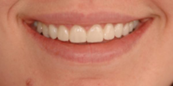 After 8 Veneers